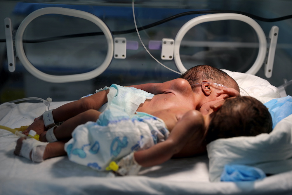 Newly born conjoined twins lie in an incubator at the child intensive care unit of Al-Sabeen hospital in Sanaa, Yemen Dec. 18, 2020. (Reuters) Newly born conjoined twins lie in an incubator at the child intensive care unit of Al-Sabeen hospital in Sanaa, Yemen Dec. 18, 2020. (Reuters)