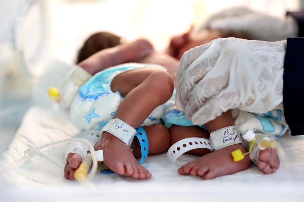 A nurse attends to newly born conjoined twins in an incubator at the child intensive care unit of Al-Sabeen hospital in Sanaa, Yemen Dec. 18, 2020. (Reuters) A nurse attends to newly born conjoined twins in an incubator at the child intensive care unit of Al-Sabeen hospital in Sanaa, Yemen Dec. 18, 2020. (Reuters)